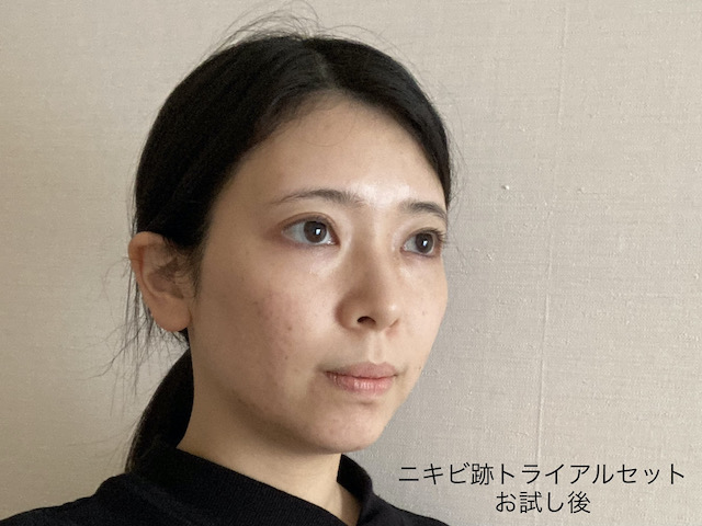 どれがいい ビーグレン全6種口コミ調査 毛穴やニキビ跡の効果は トラコス