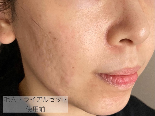 ビーグレン毛穴ケアセットの効果は 実際の体験談や効果画像を紹介 トラコス